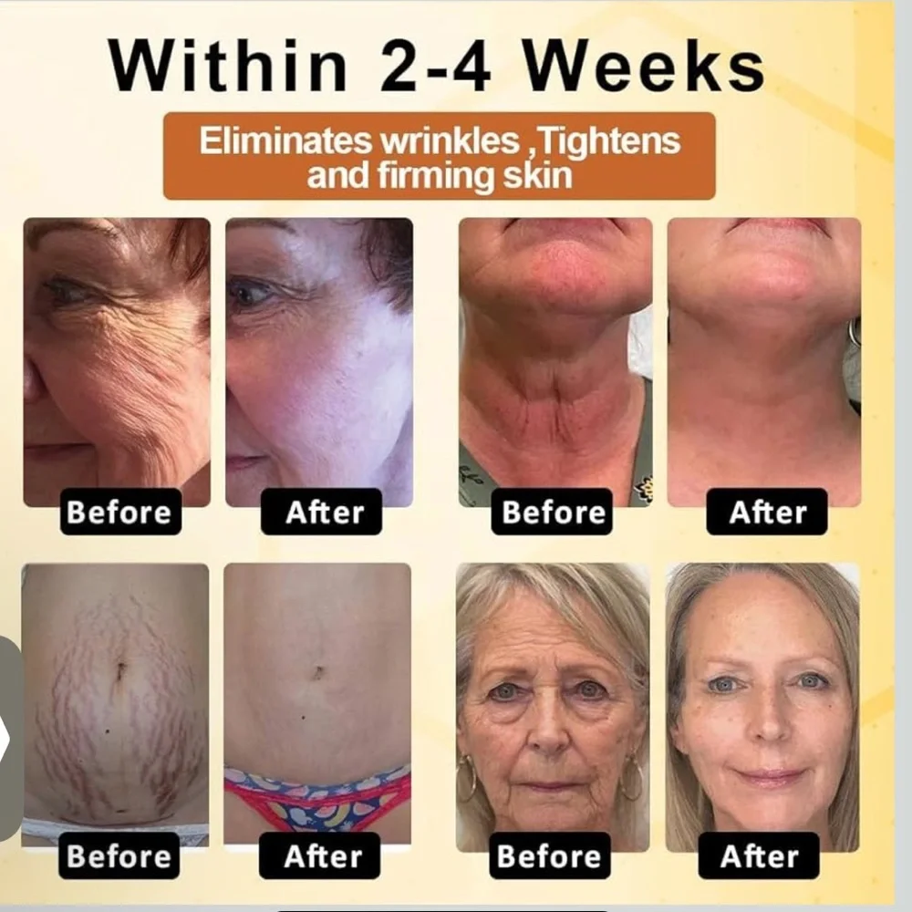 Botoxmix Bee Venom Treatment
